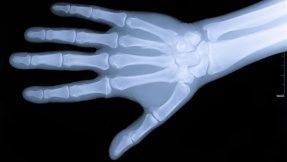 Mit Laser und Ultraschall: Scanner erkennt Rheuma