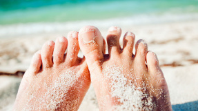 Nagelpilz erkennen und was hilft