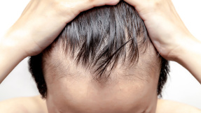 Gründe für Haarausfall: Übergewicht und Rauchen!