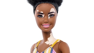 Barbie mit Pigmentstörung