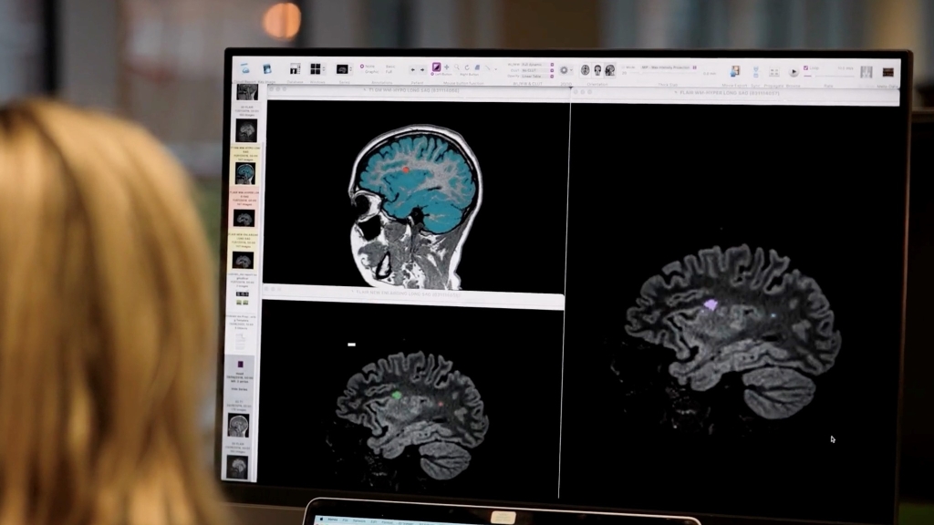 KI revolutioniert Kampf gegen Parkinson